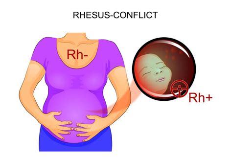 rhd positiv gravid|Rhesus